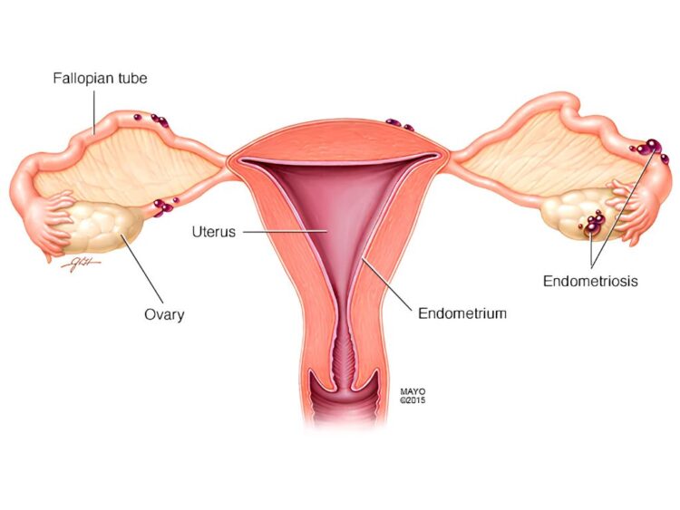 Endometriosis en México. AMEXI Foto Ilustración médica