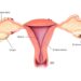 Endometriosis en México. AMEXI Foto Ilustración médica